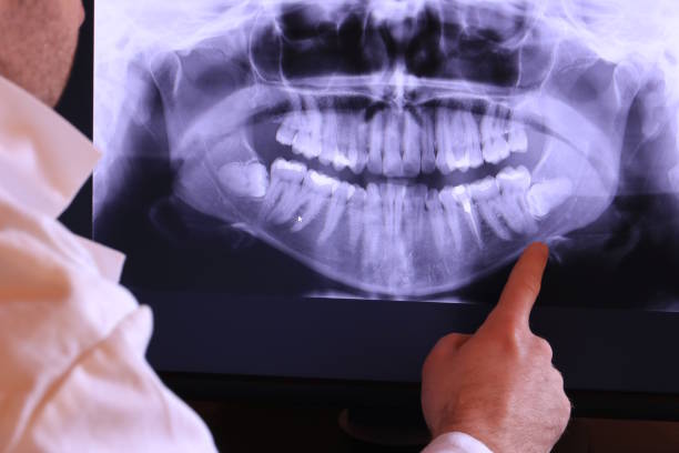 Best Knocked-Out Tooth (Avulsed Tooth) Treatment in Waynesville, OH